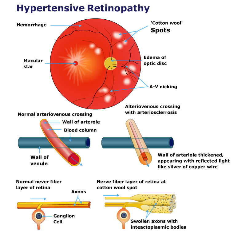 Angiogenesis and hypertensive retinopathy